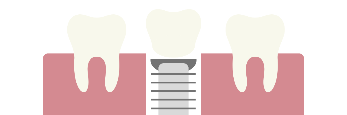 single dental implants in Crescent Lodge Dental Practice in Clapham