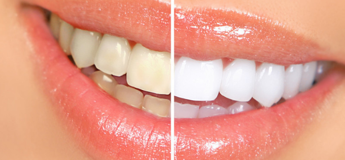 An image of a persons smile split in half down the middle vertically, showing a before and after teeth whitening here at Crescent Lodge Dental Practice.