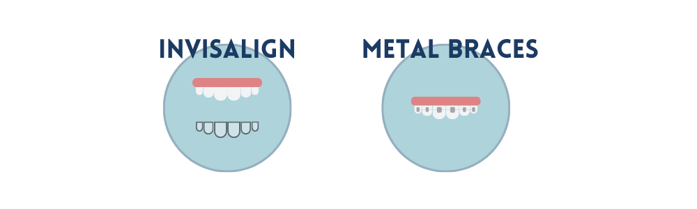 Invisalign vs metal braces