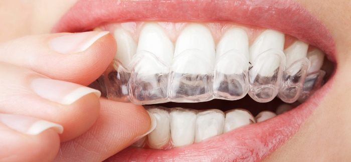 close up of someone placing Invisalign braces into their mouth