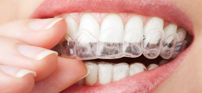 Women putting in her orthodontist Invisalign clear braces on her teeth