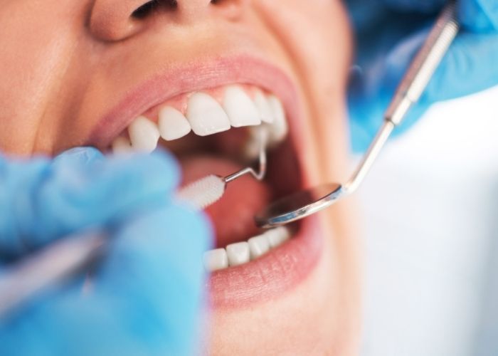 How Long Do White Fillings Last? Crescent Lodge Dental Practice