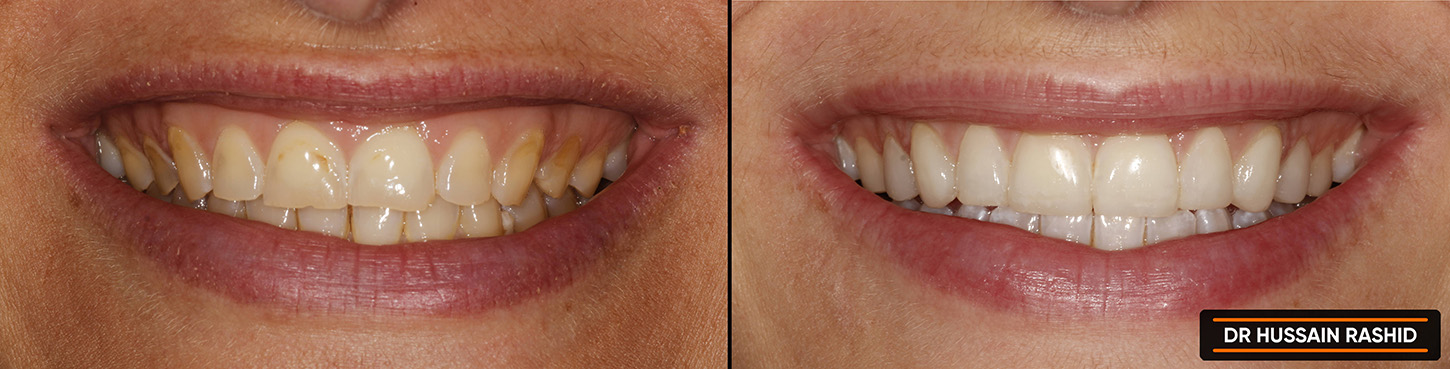 Photos of teeth prior and post teeth treatment.
