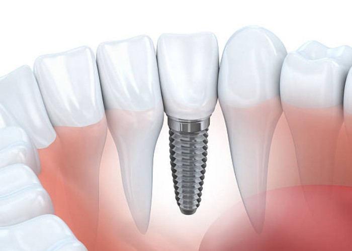 Dental Implants | Clapham Common, London
