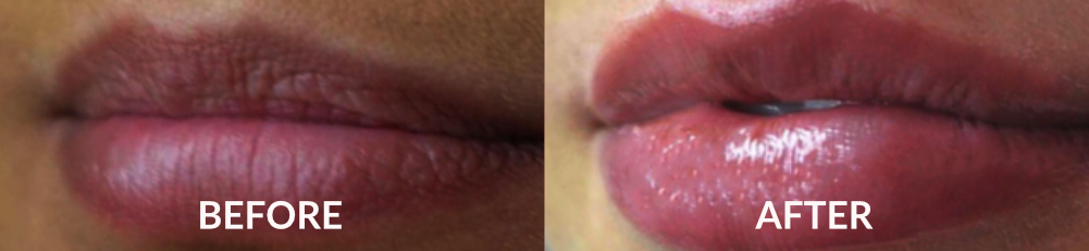 Results from lip fillers in Clapham Common, Clapham