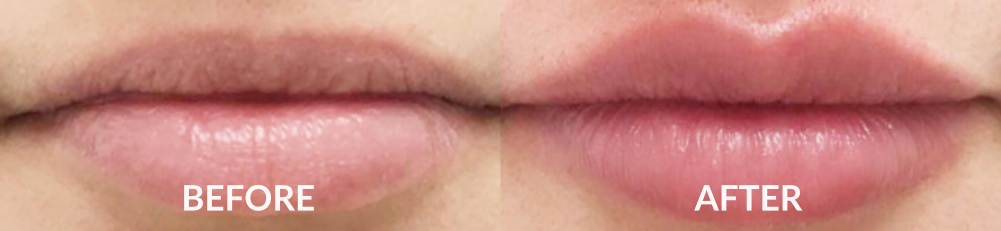 Results from lip fillers in Clapham Common, Clapham