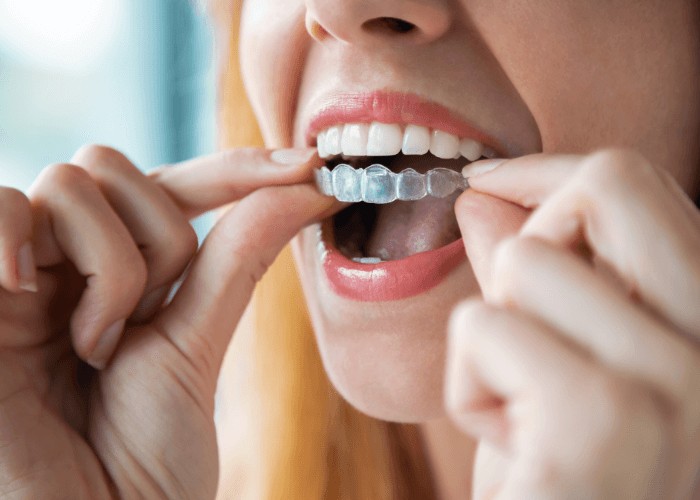 woman putting Invisalign aligners into her mouth