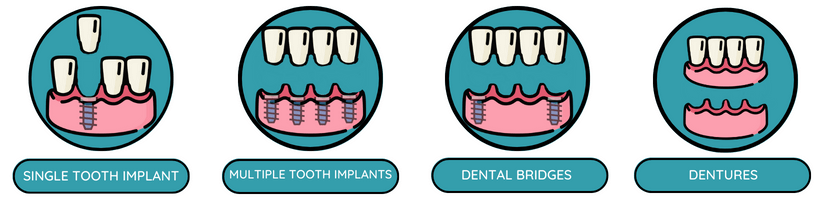 Graphic showing different types of tooth implants