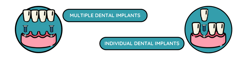 graphic showing multiple and single dental implants in London