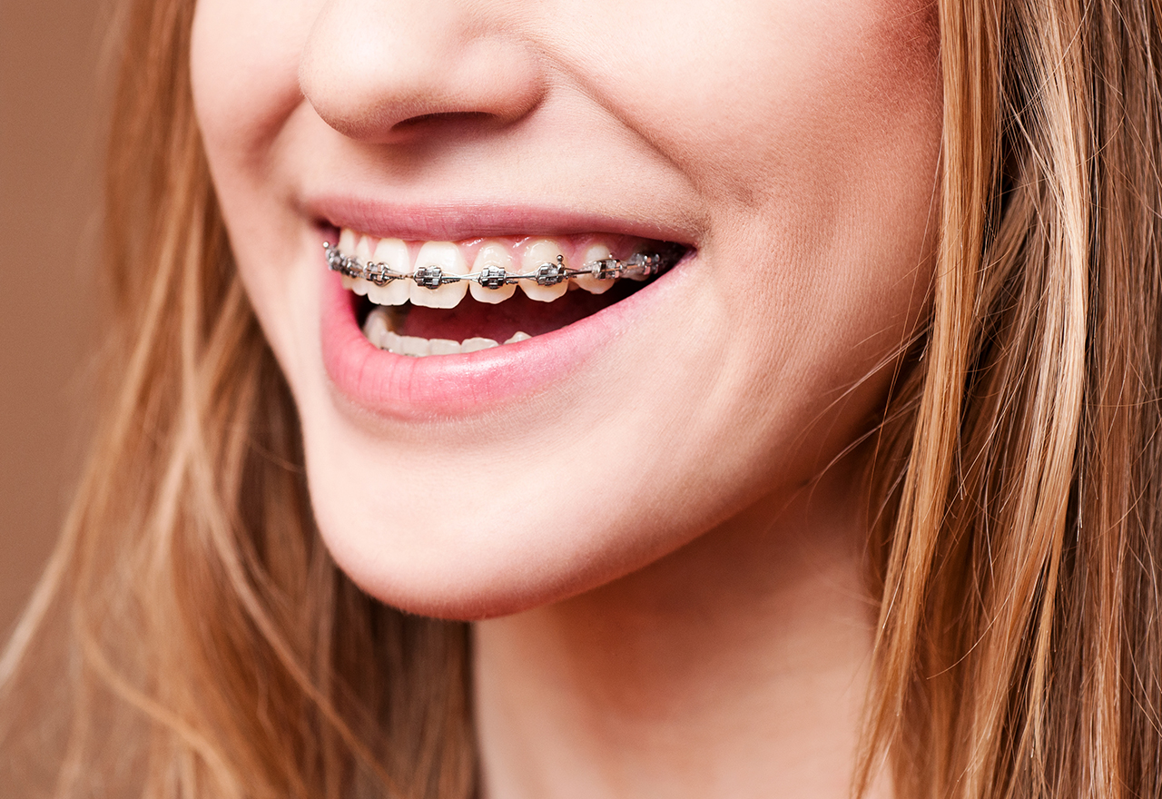 Adult woman wearing braces