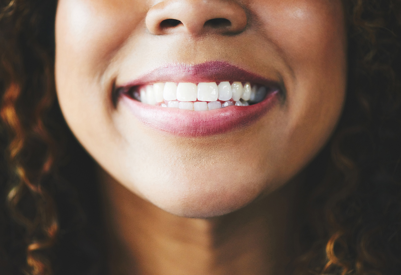 Woman's mouth smiling showing teeth with white fillings