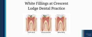 An infographic showing white fillings at Crescent Lodge Dental Practice.