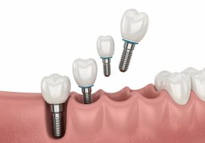 Pros and cons of dental implants