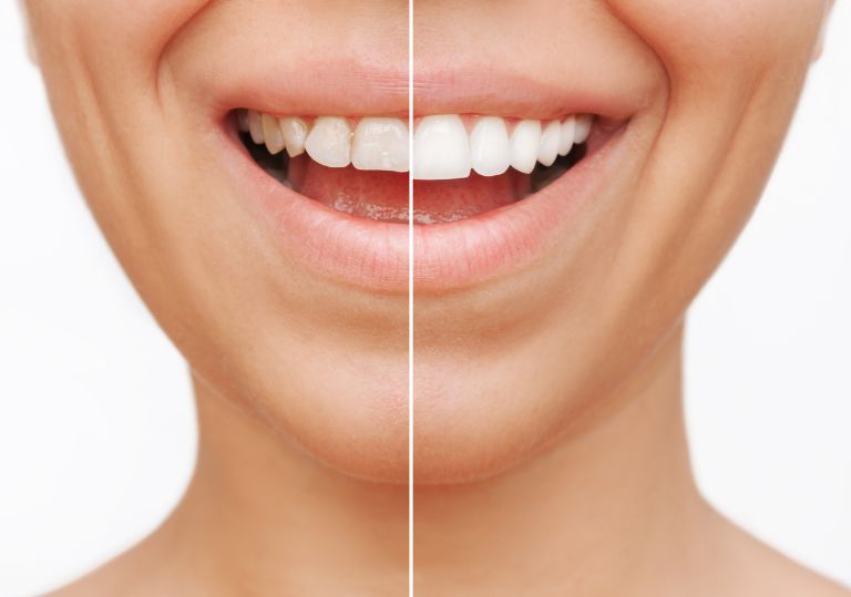 woman with teeth whitening at Clapham dental practice