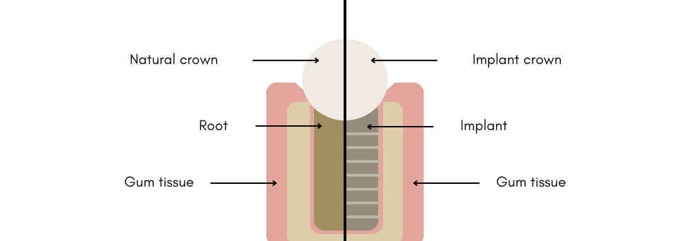 Dental implant structure at Clapham Common dentist