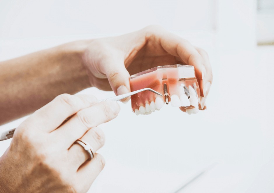 dental implants model at Clapham Common dental practice - Crescent Lodge Dental Practice