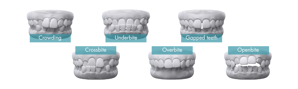 What Invisalign Can Treat - Crescent Lodge Dental Practice in Clapham, London