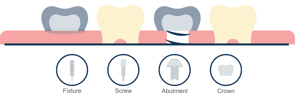 Dental implants structure at Clapham Common Dental Practice - Crescent Lodge Dental Practice