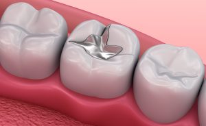 how long do metal fillings last