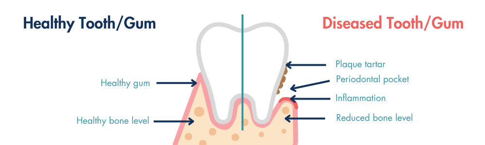 healthy gum vs damaged gum at Clapham Common Dental practice