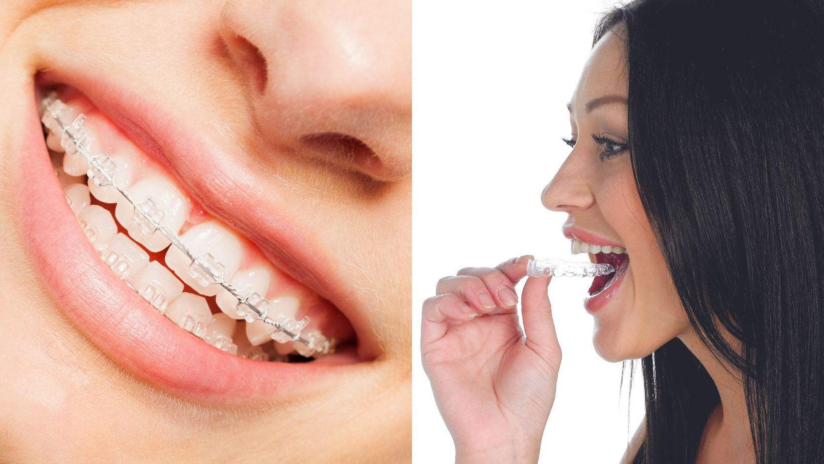 Invisalign vs braces images 