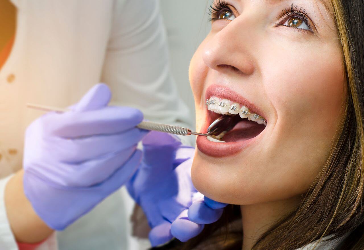 Adult Braces in London