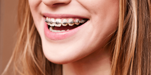 Adult braces smile 