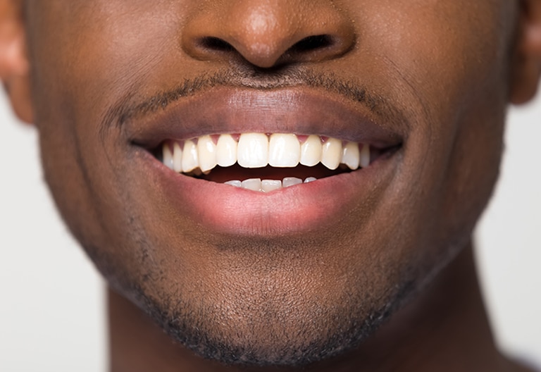 man with white fillings smiling