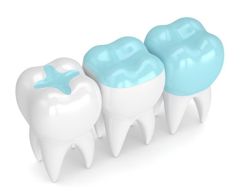 White fillings at Crescent Lodge Dental graphic