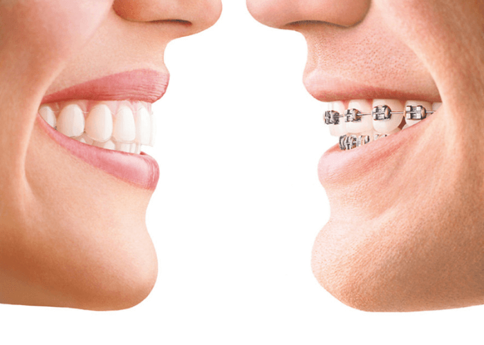 Invisalign vs Metal braces facing eachother