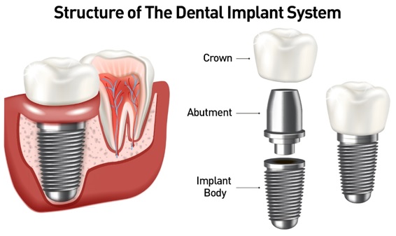 graphic showing the components of a dental implants permanent fixture